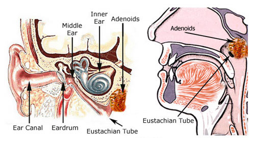 Adenoids and the Eustachian Tube